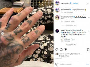 トラヴィスの左手薬指には大きな青あざが（画像は『travisbarker　2023年2月27日付Instagram「Surgery tomorrow」』のスクリーンショット）