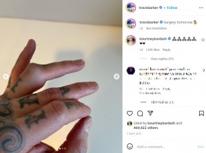 薬指が大きく腫れている（画像は『travisbarker　2023年2月27日付Instagram「Surgery tomorrow」』のスクリーンショット）