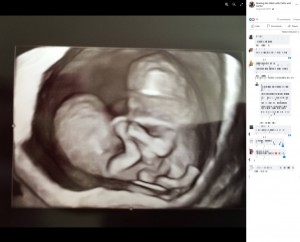 地元の病院での超音波検査で赤ちゃんが結合双生児と分かり、医師に中絶を勧められたというチェルシーさん。ショックを受けるも、「この子たちに生きるチャンスを与えたい」と妊娠を継続した（画像は『Beating the Odds with Callie and Carter　2016年8月20日付Facebook』のスクリーンショット）