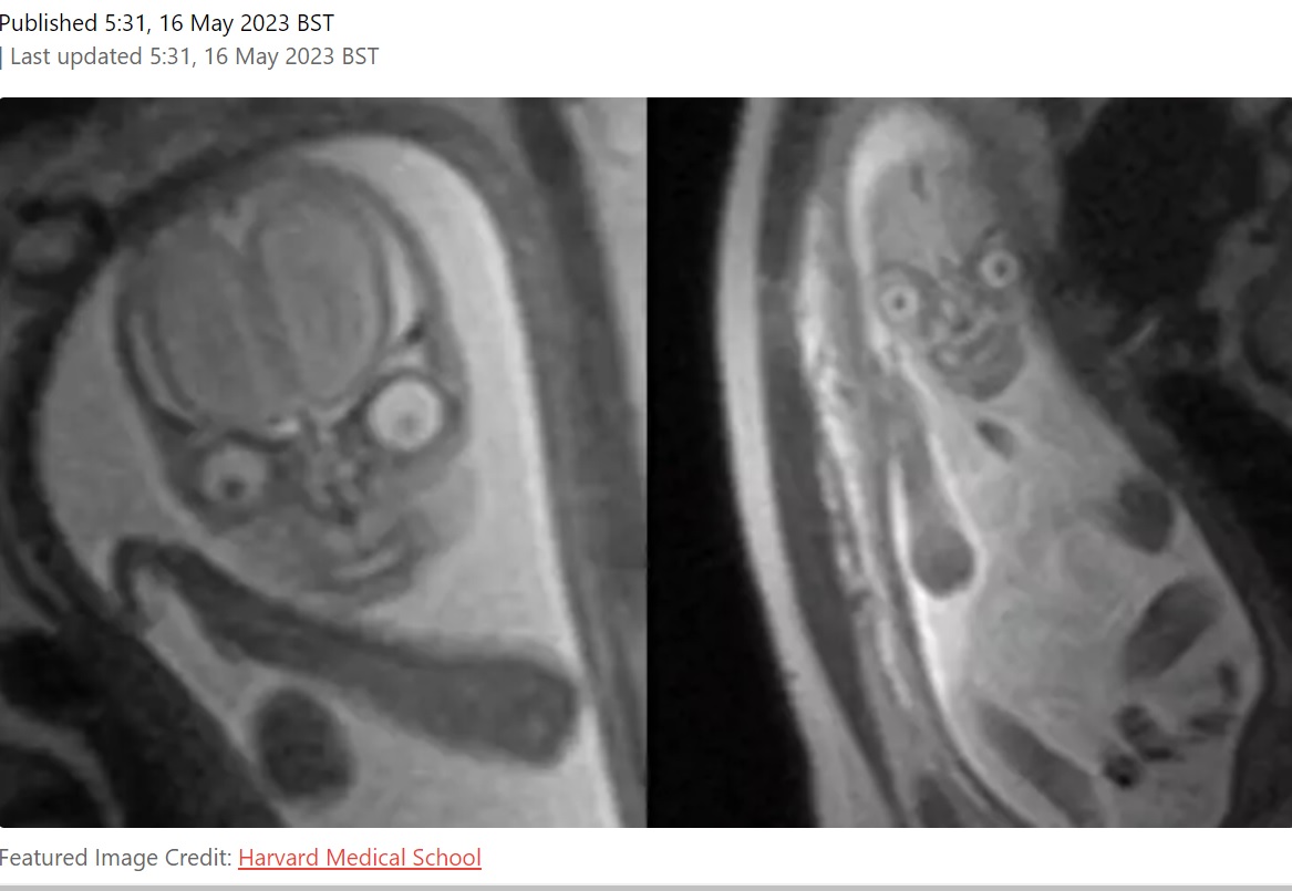 妊婦がMRI検査の赤ちゃんの写真を見ることがないのは、こんなに“怖い”結果が待っているから！　ギョロリとした目が特徴的で恐ろしい形相をしているのが分かる（画像は『LADbible　2023年5月16日付「People are horrified after seeing MRI images of a baby inside the womb」（Featured Image Credit: Harvard Medical School）』のスクリーンショット）