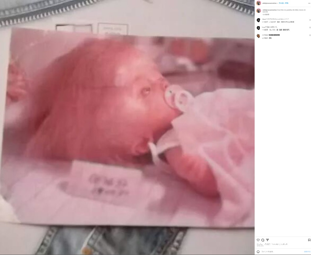 母アダルジーザさんは妊娠中に風疹にかかり、胎児が水頭症と判明した。医師は大きな頭の赤ちゃんを見て「ビッグベビー」と呼んだという（画像は『Adalgisa Soares Alves Alves　2015年3月28日付Instagram「Essa foto da graziely ela tinha meses de nascida」』のスクリーンショット）