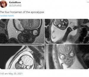 ケイティさんが厄災をもたらすことで知られる「ヨハネの黙示録の四騎士」と説明した、胎児の4枚の顔の写真。「まるで呪われた赤ちゃんだ」といったコメントも（画像は『Katie　2021年5月20日付Twitter「The four horsemen of the apocalypse」』のスクリーンショット）