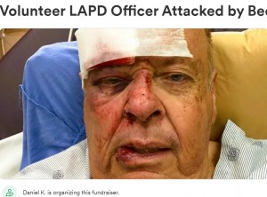 ハチに襲われ、地元の病院に搬送されたゲイリーさん。体の数十か所を刺されたうえ、ハチを手で追い払おうとして転倒、眼球を支えている薄い骨（眼窩底）を骨折した（画像は『GoFundMe　2023年5月17日付「Volunteer LAPD Officer Attacked by Bees」』のスクリーンショット）