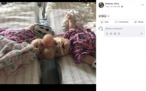 ペンシルベニア州フィラデルフィアの「フィラデルフィア小児病院で、2017年6月6日に行われた分離手術前の2人。頭部の皮膚を伸展させて手術に備えた（画像は『Delaney Twins　2023年6月7日付Facebook「*HAPPY SEPARATION DAY*」』のスクリーンショット）