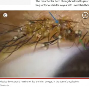 3歳男児の右上まつ毛に沿うようにアタマジラミ（青の矢印）が見つかった。さらにまつ毛の根元には海ぶどうのような卵（緑の矢印）が多数付着しており、医師を驚愕させた（画像は『New York Post　2023年7月7日付「Disturbing photos show lice nesting in 3-year-old’s eyelashes」（Elsevier Inc.）』のスクリーンショット）