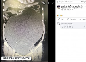 手術前の画像検査の写真では卵巣の腫瘍がまるで腹部全体を埋め尽くしているようにも見え、医師らは摘出手術を決断した（画像は『งานห้องผ่าตัด โรงพยาบาลบึงกาฬ : Operating room Bungkan hospital　2023年7月18日付Facebook「17/07/2566  TAH ＆ BSO」』のスクリーンショット）