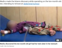 【海外発！Breaking News】腹痛を訴える生後10か月の女児の腹部から、未発達の双子の片割れ（パキスタン）