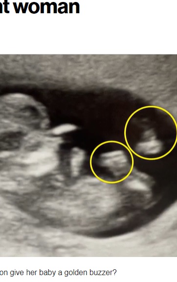 米ジョージア州の妊婦ヘイリーさんの超音波検査の画像。母に送ると「セレブ2人が映り込んでいる」と名前を挙げたという（画像は『New York Post　2023年9月13日付「I see ‘American Idol’ judges in my ultrasound: pregnant woman」（Kennedy News ＆ Media）』のスクリーンショット）