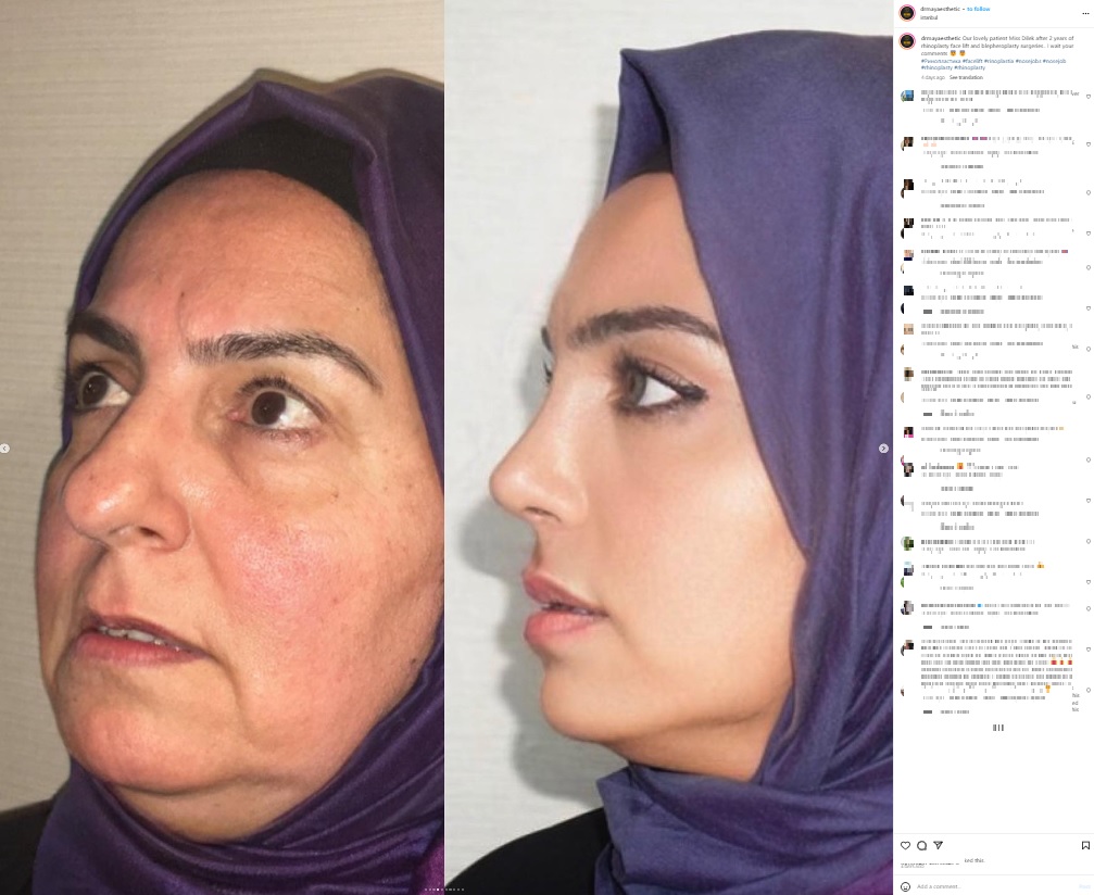 見事な変貌に「これはクレイジーだ。少なくとも20歳は若くなってるぞ！」「母と娘のようだ」「別人でしょう！」「目の色が違うわよ」「フェイクでしょう」とSNSは大炎上（画像は『Dr. MAY Facial Plastic Surgery　2023年9月11日付Instagram「Our lovely patient Miss Dilek after 2 years of rhinoplasty face lift and blepheroplasty surgeries..」』のスクリーンショット）