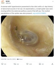 【海外発！Breaking News】女性の左耳の中に生きたクモ！　脱皮をした抜け殻も見つかる（台湾）＜動画あり＞