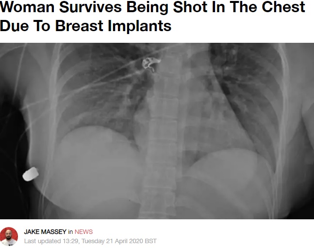 カナダのオンタリオ州で2018年、左胸に銃弾を受けた女性。豊胸手術で挿入したシリコンインプラントによって弾丸が留まり、命拾いした（画像は『LADbible　2020年4月21日付「Woman Survives Being Shot In The Chest Due To Breast Implants」（Credit: Plastic Surgery Case Studies/McEvenue）』のスクリーンショット）