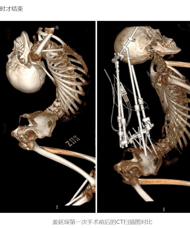 手術前（左）と5月25日の1回目の手術後のCTスキャン。曲がっていた骨が伸び、首の位置が大きく違うのが良く分かる（画像は『中国宁波网　2023年11月14日付「身体折叠180度 他在北大医院顺利手术」』のスクリーンショット）