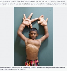 印ジャールカンド州在住の16歳少年は「巨指症」を患い2014年に手術を受けるも、納得のいく結果を得ることはできなかった。それでも少年は「僕はなんだってできる」と前向きに語っていた（画像は『The Mirror　2015年8月14日付「‘Boy with the World’s Biggest Hands’ measuring 33cm has surgery to reduce their size」（Image: Barcroft）』のスクリーンショット）