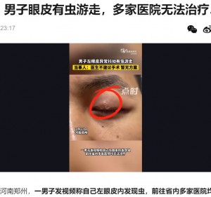 中国在住の男性が今年2月、瞼の下に糸状の寄生虫が蠢いている姿を投稿。「お勧めの専門医を知っている人はいるかな？」とユーザーに尋ねた後、北京で専門医の治療を受けていた（画像は『捜狐　2023年2月24日付「可怕！男子眼皮有虫游走，多家医院无法治疗…」』のスクリーンショット）
