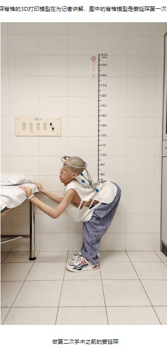 1回目の手術後の江さん。それまでは立つことができなかった江さんだが、なんとか首を上げてつかまり立ちができている（画像は『北京大学新闻网　2023年9月8日付「为“折叠男孩”打开人生」』のスクリーンショット）
