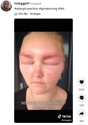 2016年、オーストラリアのサロンで頼んでもいない眉ティントをされてしまった女性。アレルギー反応を起こして顔が腫れ上がり「目が完全にふさがって、何も見えない状態が24時間続いた」と明かしていた（画像は『tcleggett　2022年4月17日付TikTok「＃allergicreaction ＃gonewrong ＃fail」』のスクリーンショット）
