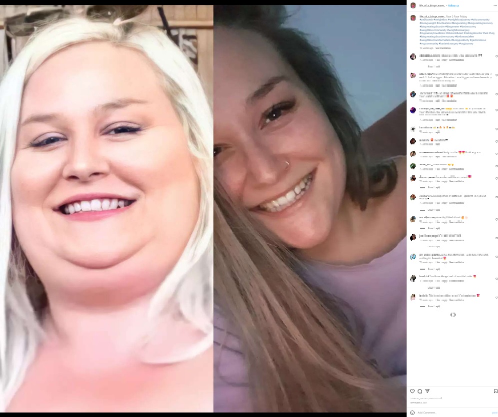 体重170キロにまで達し、「座礁クジラ」と呼ばれたニュージーランド在住の女性。2020年4月に「スリーブ状胃切除術」を受け、92キロの減量に成功していた（画像は『Life Of A Binge Eater　2021年9月3日付Instagram「Face 2 Face Friday」』のスクリーンショット）