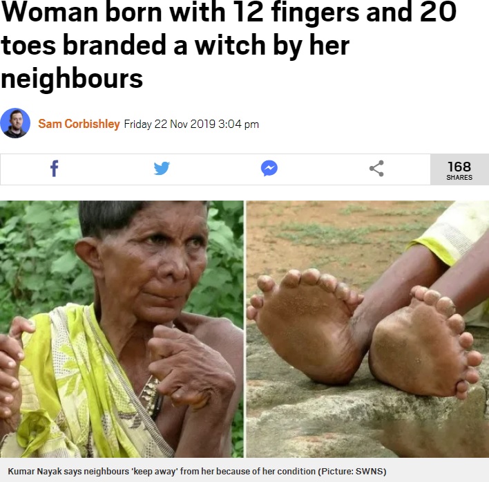 20本の足指と12本の手指を持つインド住む女性。2019年にメディアのインタビューに応じ、「魔女だから近づくな」と忌み嫌われながら63年間を過ごしてきたことを語っていた（『Metro　「Woman born with 12 fingers and 20 toes branded a witch by her neighbours」（Picture: SWNS）』より）