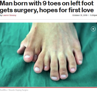 左の足指が9本もあった中国広東省在住の男性が2019年、足の再建手術を受けた。両親が「多指は幸運をもたらす」と信じて疑わなかったことから、男性は21歳になって初めて手術を受けたという（『New York Post　「Man born with 9 toes on left foot gets surgery, hopes for first love」（AsiaWire / Shunde Heping Surgica）』より）