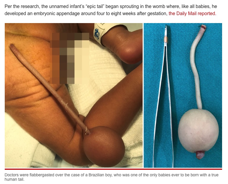 医学雑誌『Journal of Pediatric Surgery Case Reports』に2021年3月、紐状の突起物の先にボールのような球体の“尻尾”を持つブラジルの男児の症例が掲載された（『New York Post　「Baby born with rare tail gets his ‘ball and chain’ removed」』より）