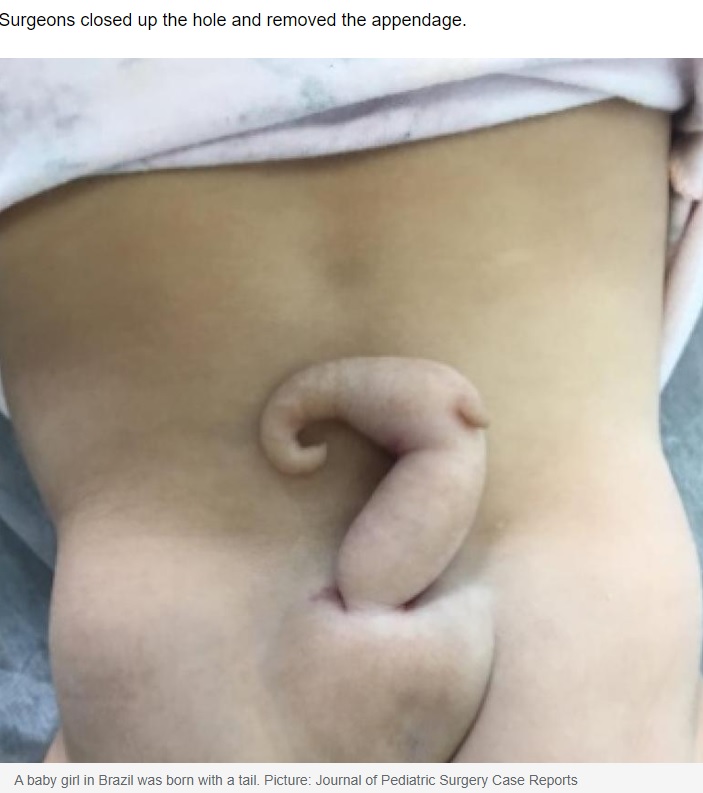 ブラジルで2020年、豚の尻尾のような約6センチの突起物が生えた女児が誕生し「非常に珍しいケース」として医師を驚愕させていた（『news.com.au　「Brazilian baby girl born with 6 cm long tail」（Picture: Journal of Pediatric Surgery Case Reports）』より）