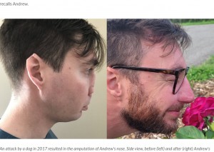 事故の後、鼻は平らで2つの穴がむき出しになり、自信と自分らしさをなくしていたというアンドリューさん（左）。14回の手術後に見事な変身を遂げた（『Cleveland Clinic　「Complete Nose Reconstruction Restores Man’s Confidence After Amputation」』より）