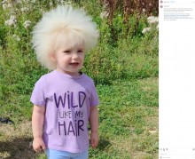 【海外発！Breaking News】まるでタンポポの綿毛のよう「櫛でとかせない頭髪症候群」の3歳女児（英）＜動画あり＞