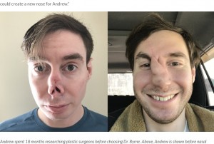 4年間で14回もの手術に耐えてきたアンドリューさん。鼻全体の再建は非常に難しい形成外科手術だが、バーン医師は新しい鼻を作ることに自信を持っていたという（『Cleveland Clinic　「Complete Nose Reconstruction Restores Man’s Confidence After Amputation」』より）
